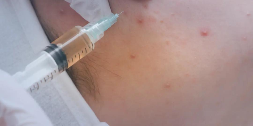 International Post Graduate Program In Advanced Dermatology